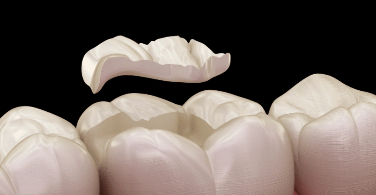 Cost of Tooth Filling in Turkey vs UK inblog